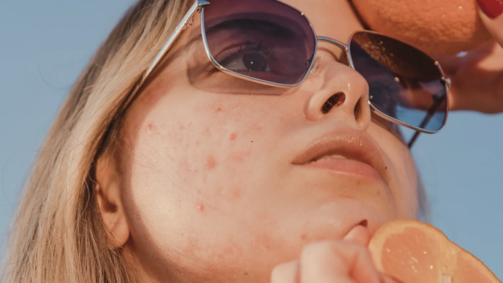 Leonardtown Acne Dermatologist Appointments